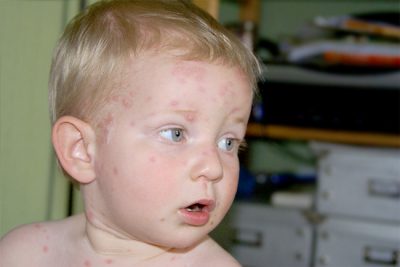 Varicela: 3 consejos para evitar que los niños se rasquen