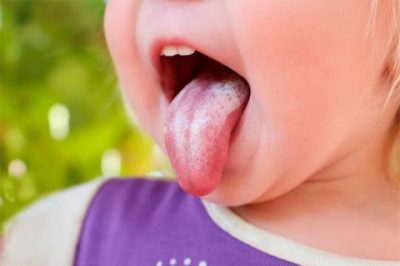 Muguet o candidiasis oral en bebés: Prevención y tratamiento